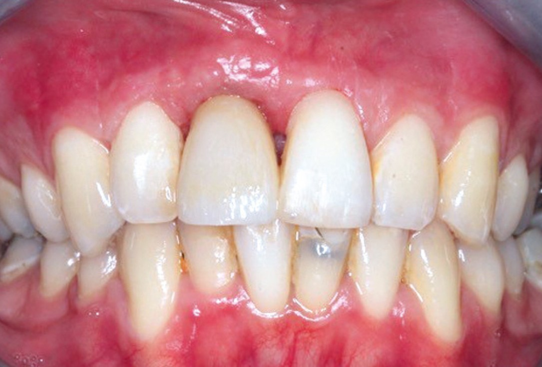 Ridge preservation with permamem®, maxgraft® granules and autologous bone - Dr. E. Valdimarsson