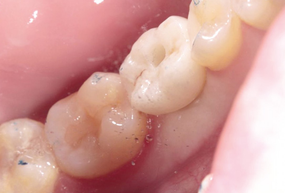 Socket preservation with permamem® and maxgraft® granules - Dr. P. Di Capua