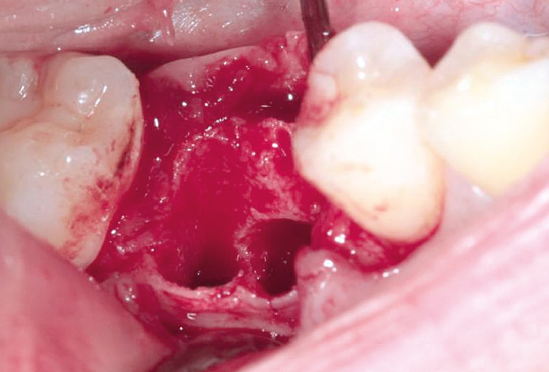 Socket preservation with permamem® and maxgraft® granules - Dr. P. Di Capua
