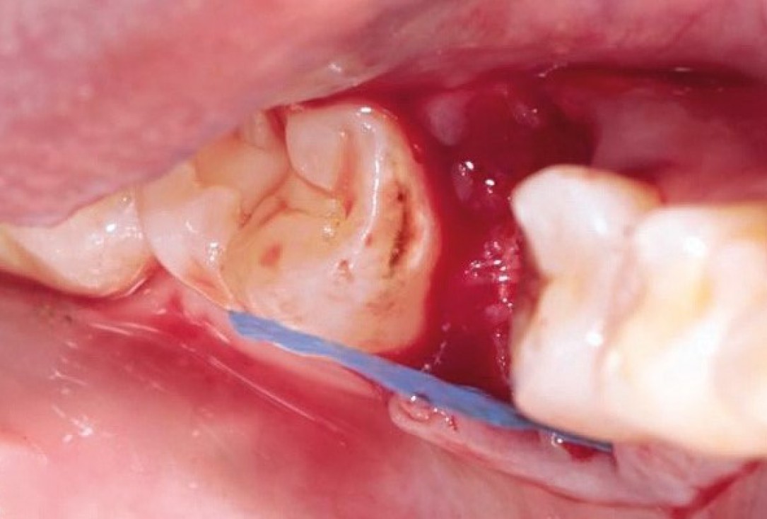 Socket preservation with permamem® and maxgraft® granules - Dr. P. Di Capua