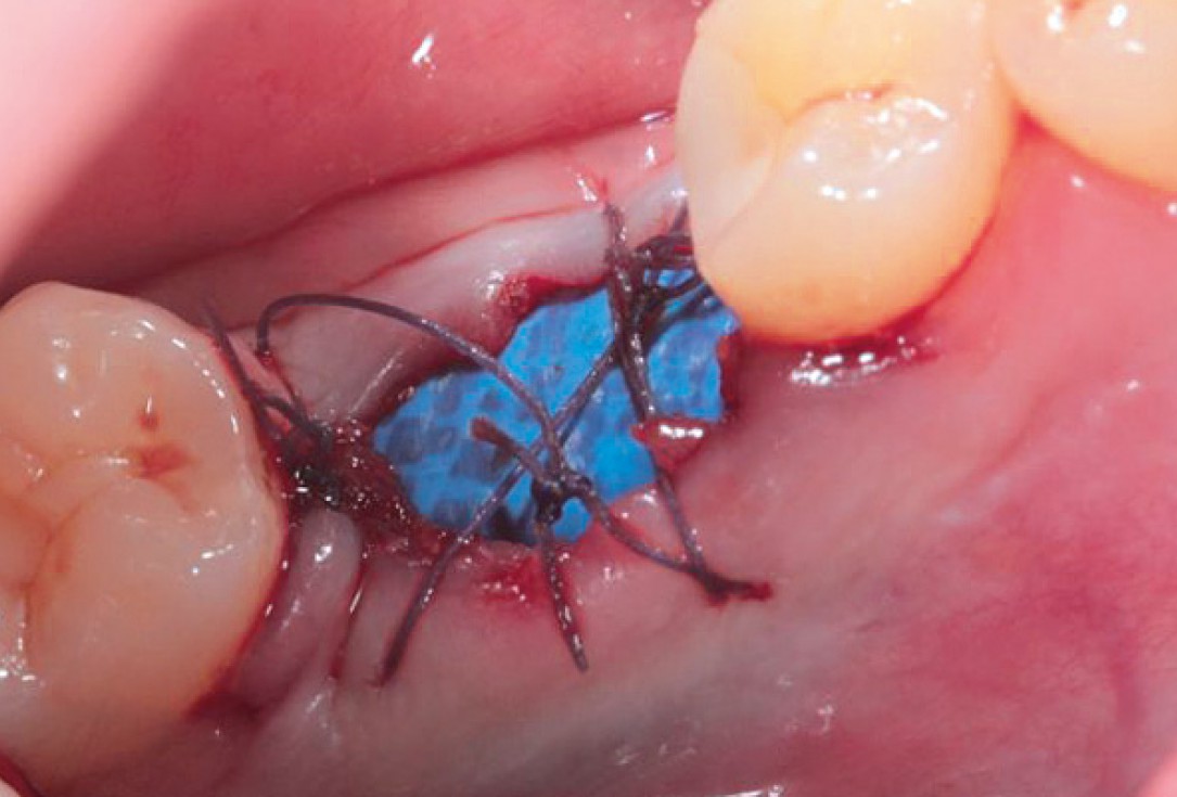 Socket preservation with permamem® and maxgraft® granules - Dr. P. Di Capua