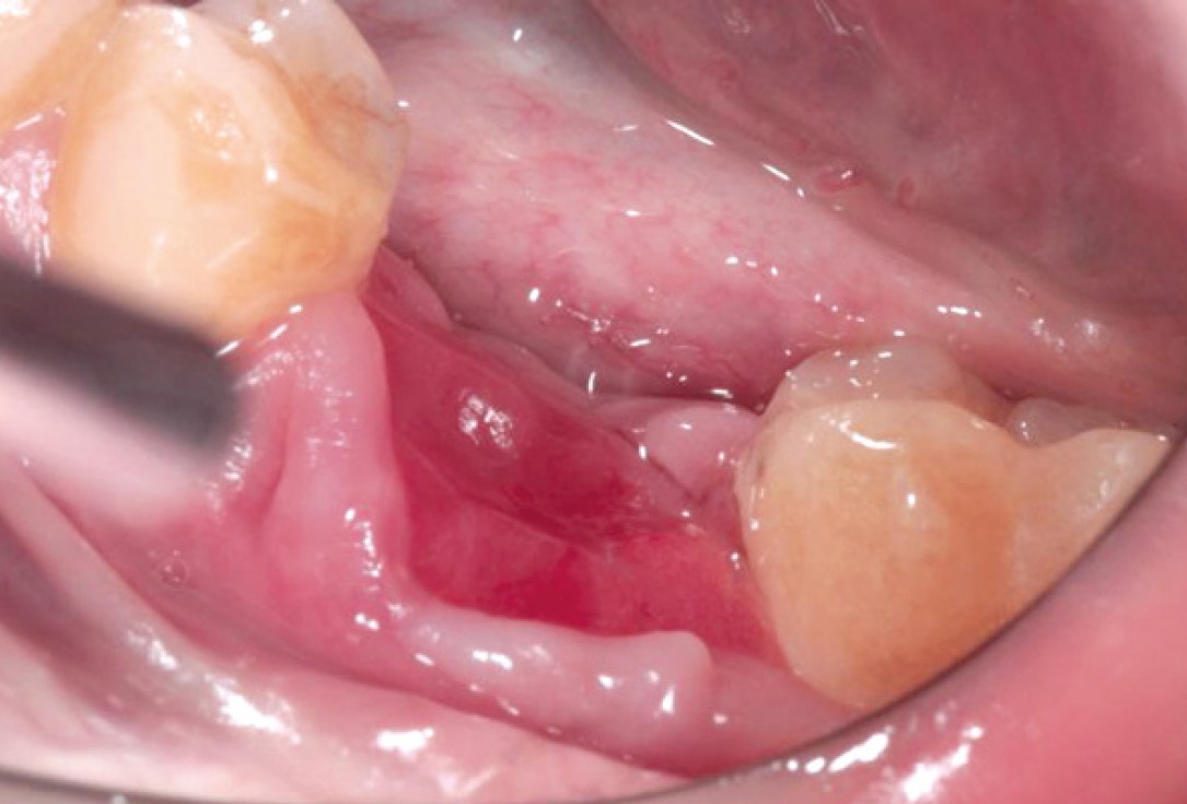 Socket preservation with permamem® and maxgraft® granules - Dr. P. Di Capua