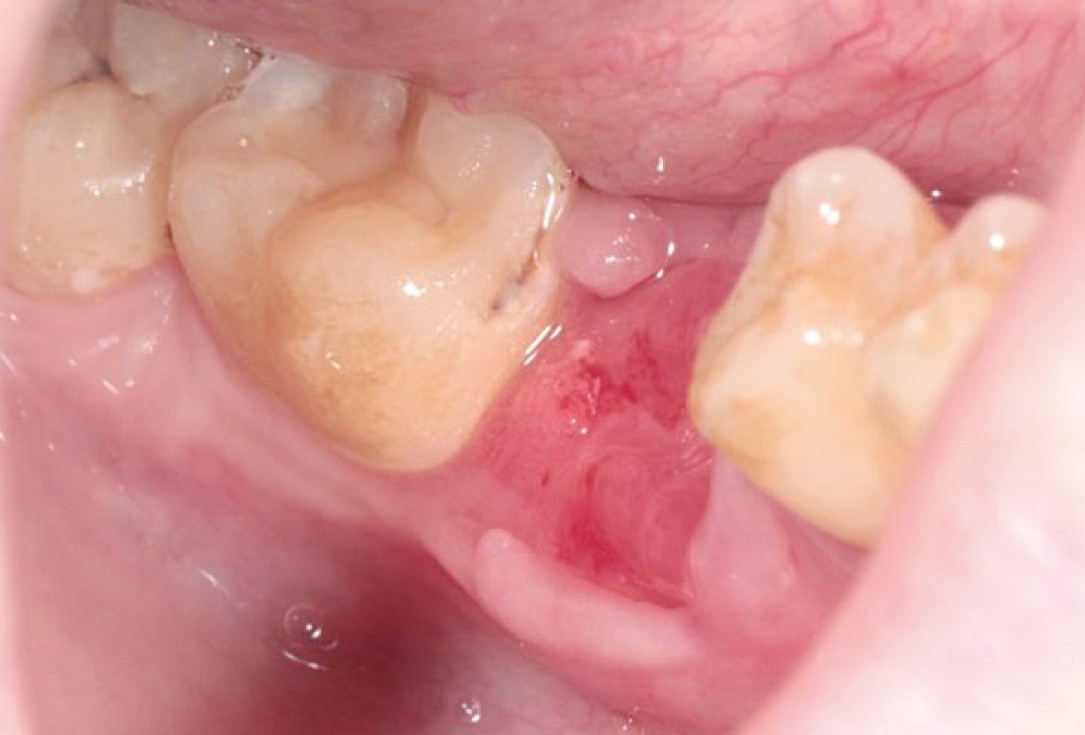 Socket preservation with permamem® and maxgraft® granules - Dr. P. Di Capua