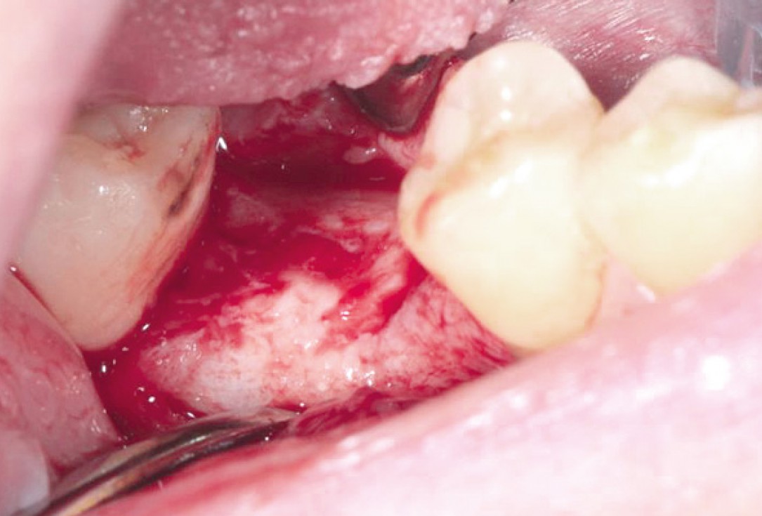 Socket preservation with permamem® and maxgraft® granules - Dr. P. Di Capua