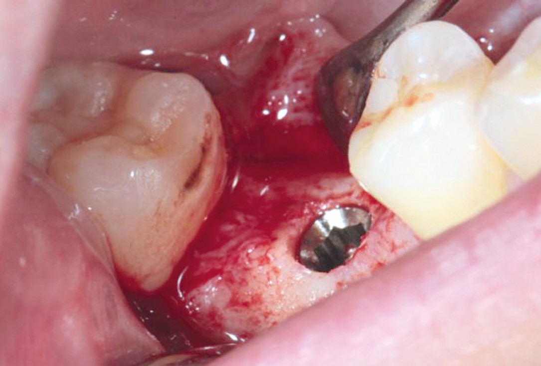 Socket preservation with permamem® and maxgraft® granules - Dr. P. Di Capua