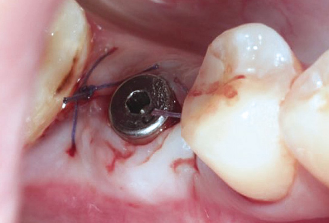 Socket preservation with permamem® and maxgraft® granules - Dr. P. Di Capua