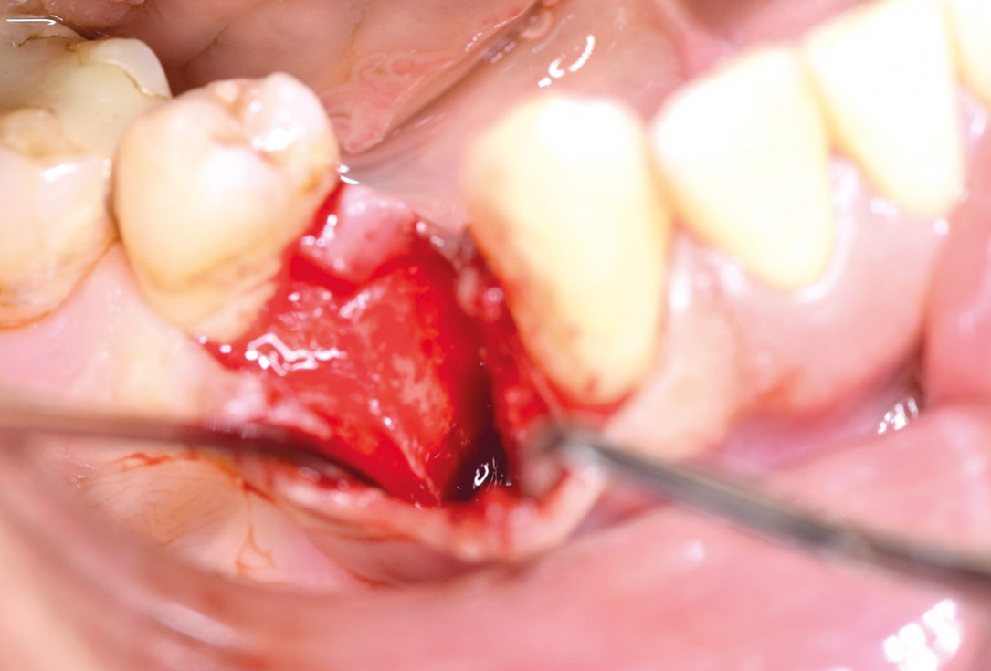 Ridge preservation using permamem® and maxgraft® granules - Dr. A. Wöst