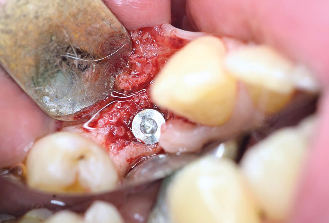 Ridge preservation using permamem® and maxgraft® granules - Dr. A. Wöst