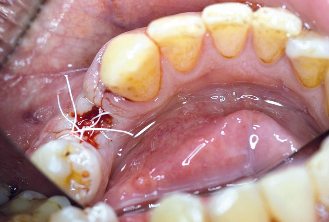 Ridge preservation using permamem® and maxgraft® granules - Dr. A. Wöst