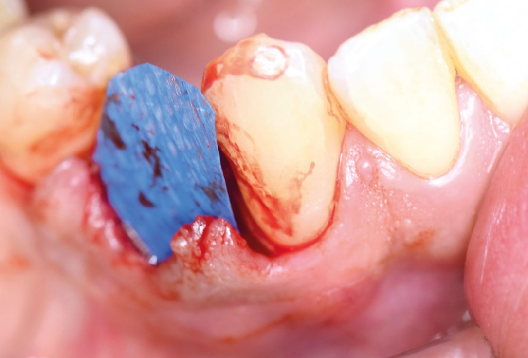 Ridge preservation using permamem® and maxgraft® granules - Dr. A. Wöst