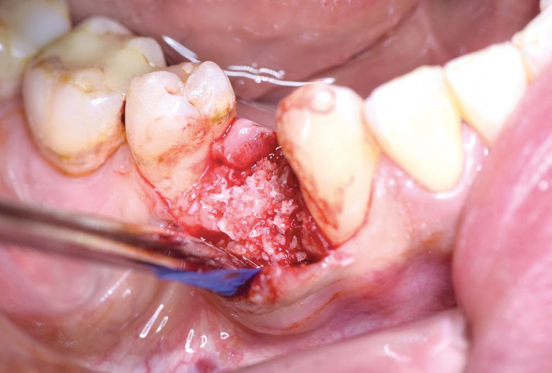 Ridge preservation using permamem® and maxgraft® granules - Dr. A. Wöst