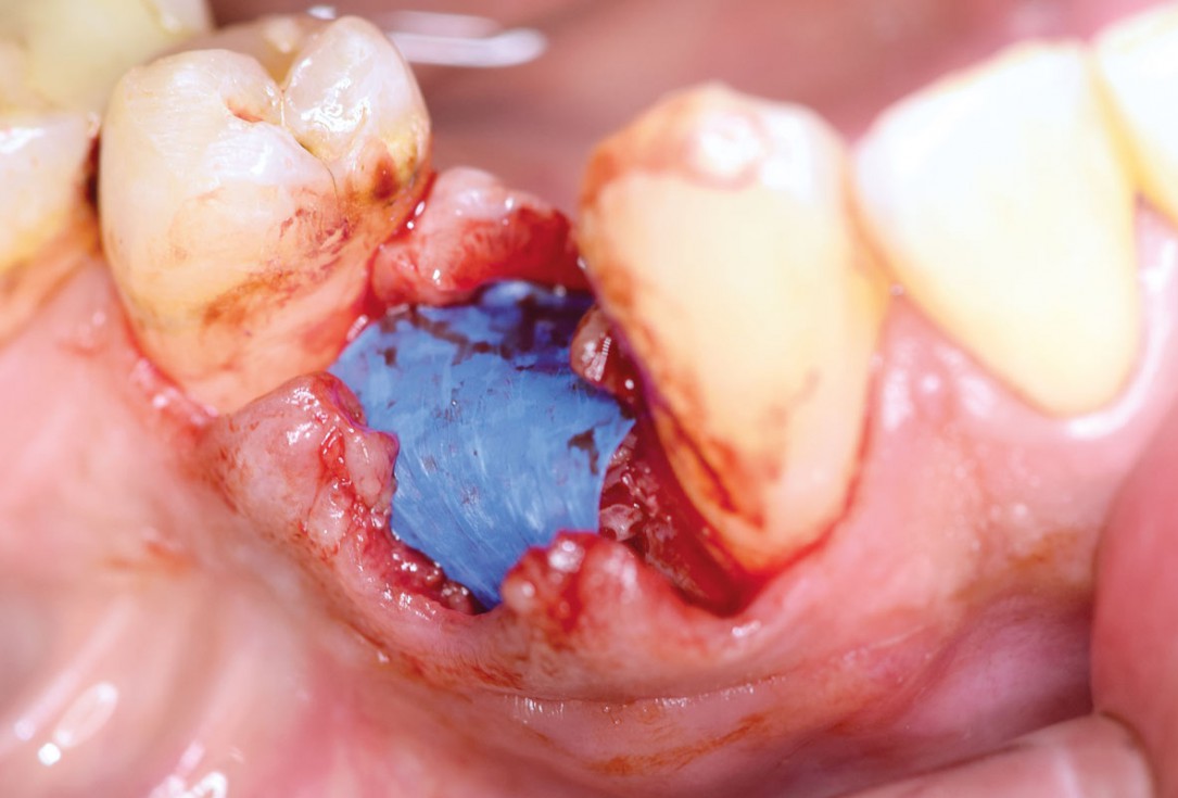 Ridge preservation using permamem® and maxgraft® granules - Dr. A. Wöst