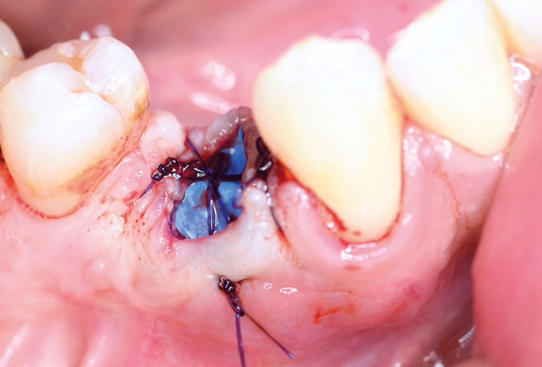 Ridge preservation using permamem® and maxgraft® granules - Dr. A. Wöst