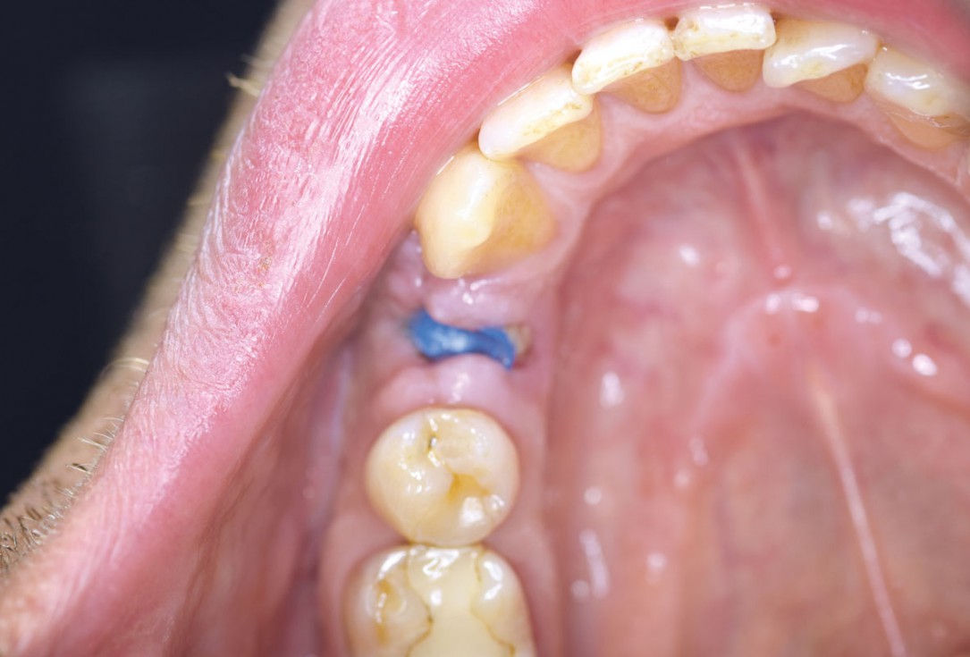 Ridge preservation using permamem® and maxgraft® granules - Dr. A. Wöst
