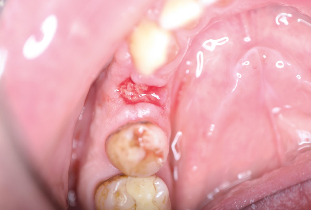 Ridge preservation using permamem® and maxgraft® granules - Dr. A. Wöst