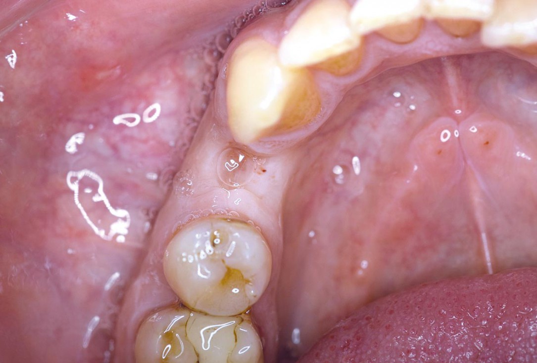 Ridge preservation using permamem® and maxgraft® granules - Dr. A. Wöst