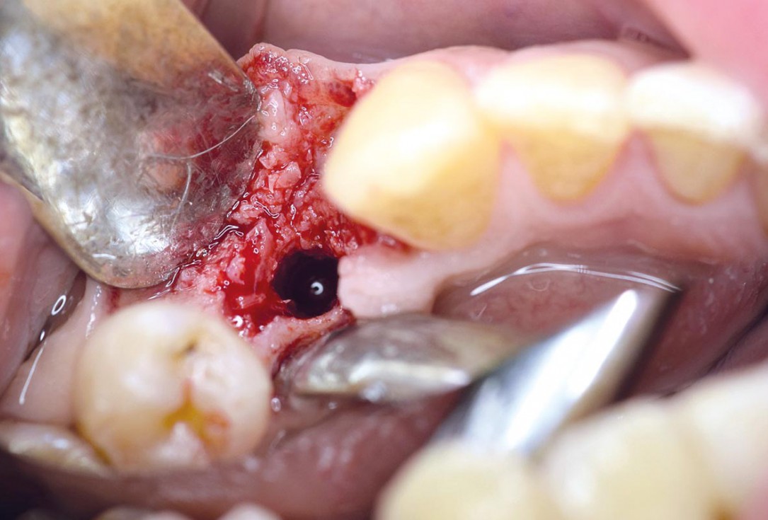 Ridge preservation using permamem® and maxgraft® granules - Dr. A. Wöst