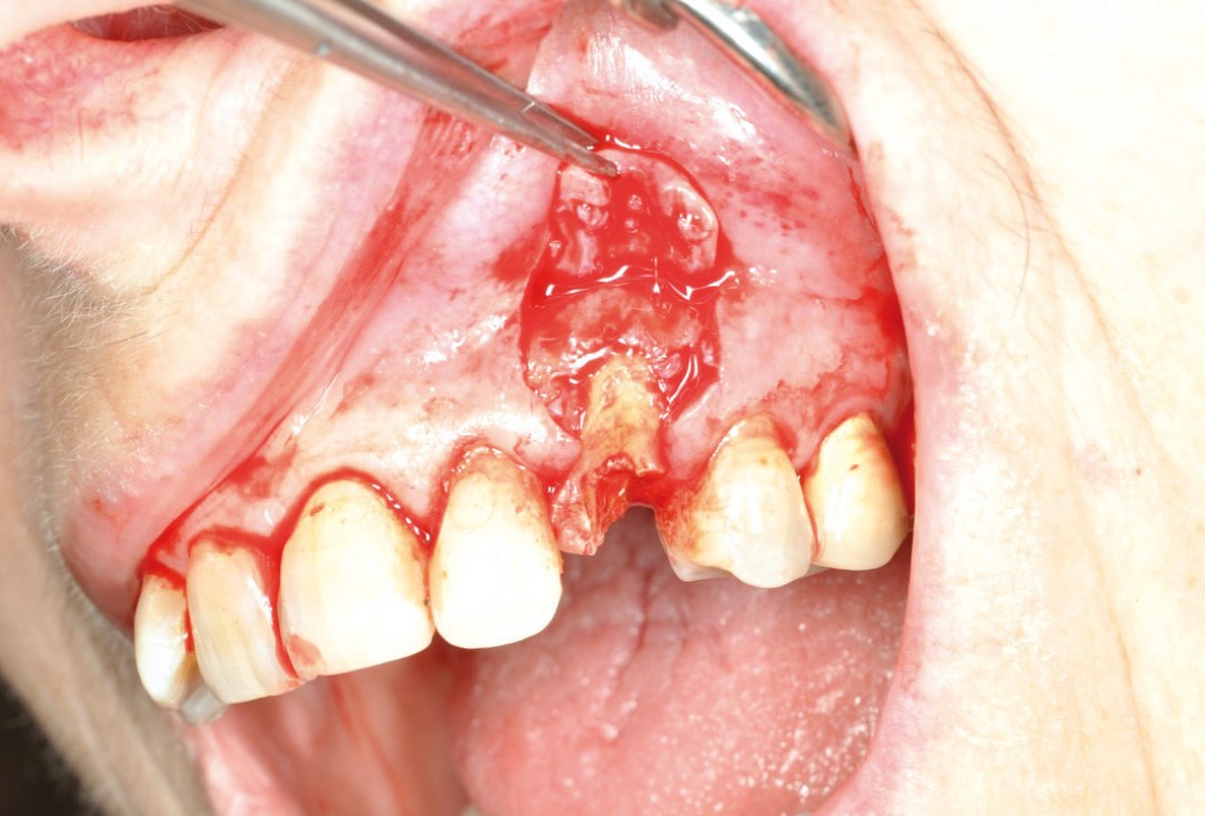 Ridge preservation and reconstruction of the buccal wall using permamem® and cerabone® - Dr. M. Steigmann