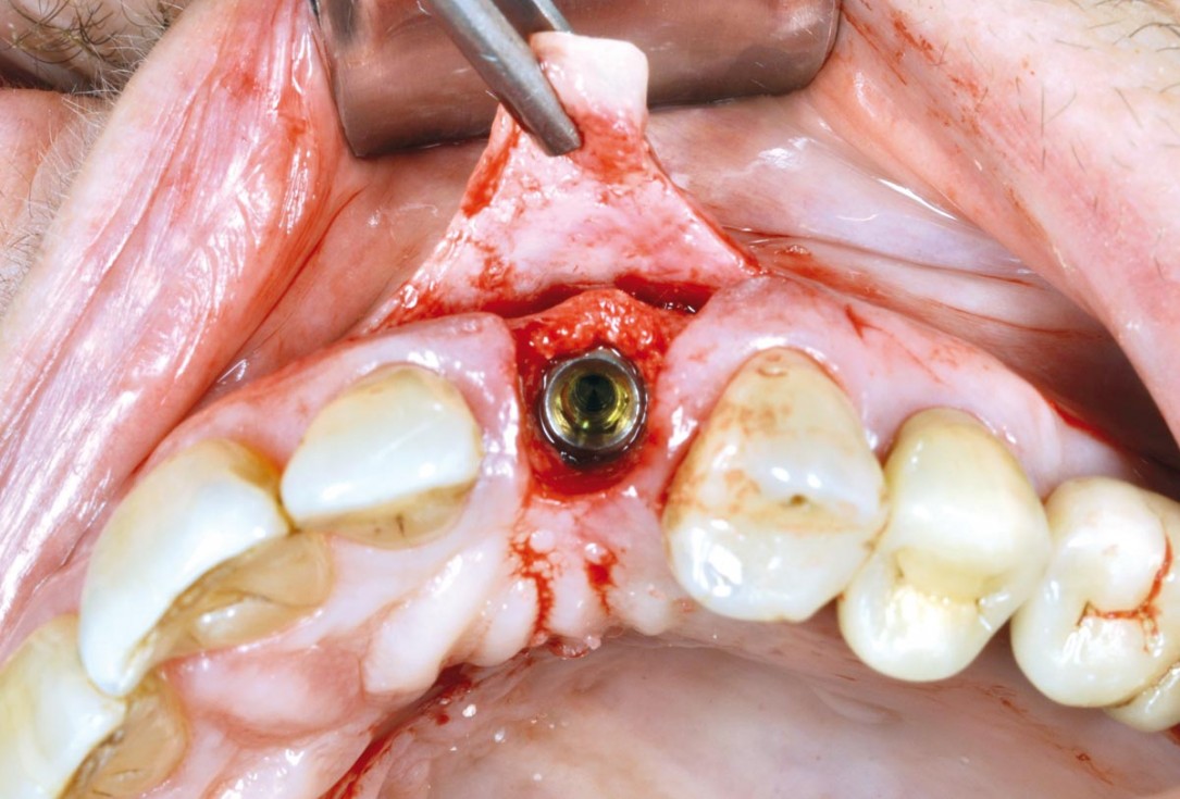 Ridge preservation and reconstruction of the buccal wall using permamem® and cerabone® - Dr. M. Steigmann