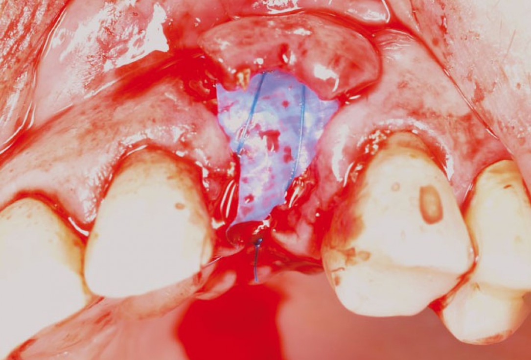 Ridge preservation and reconstruction of the buccal wall using permamem® and cerabone® - Dr. M. Steigmann