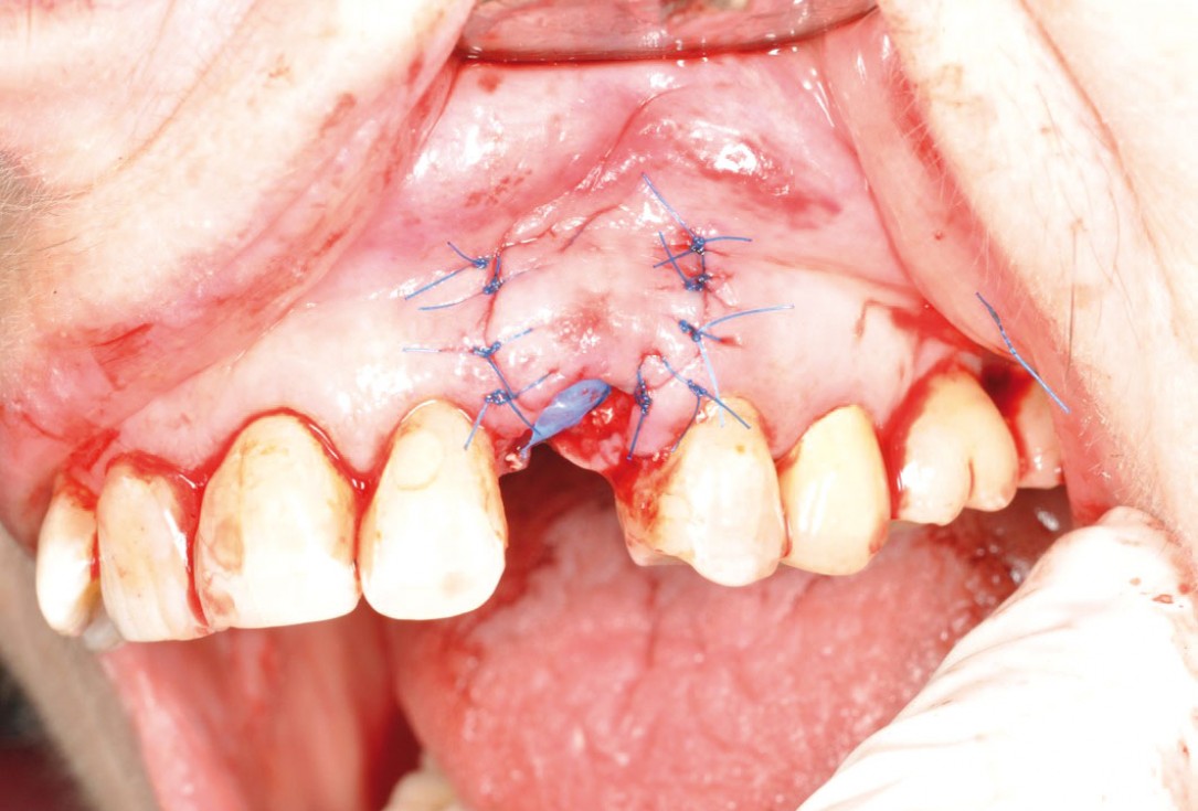 Ridge preservation and reconstruction of the buccal wall using permamem® and cerabone® - Dr. M. Steigmann