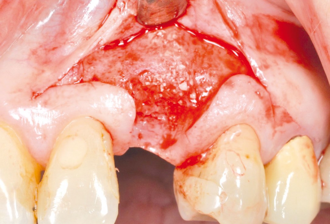 Ridge preservation and reconstruction of the buccal wall using permamem® and cerabone® - Dr. M. Steigmann