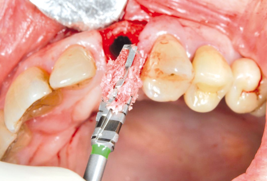 Ridge preservation and reconstruction of the buccal wall using permamem® and cerabone® - Dr. M. Steigmann