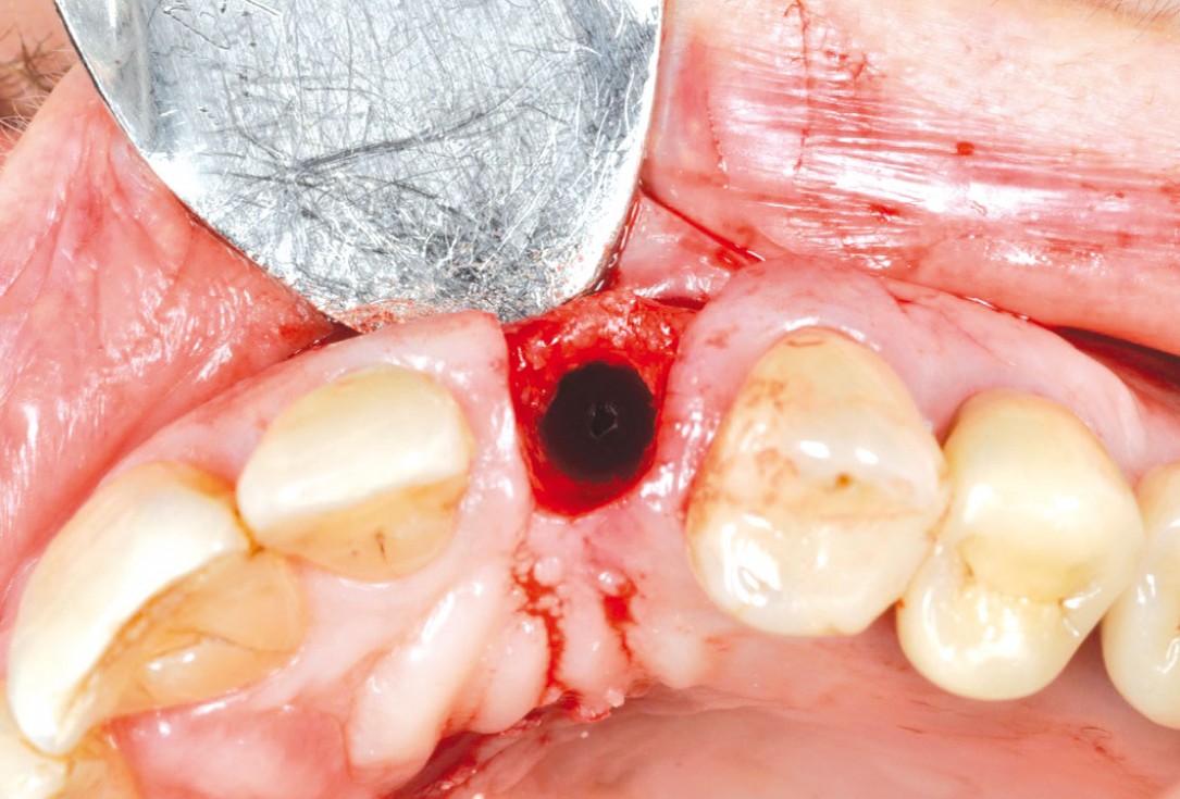 Ridge preservation and reconstruction of the buccal wall using permamem® and cerabone® - Dr. M. Steigmann