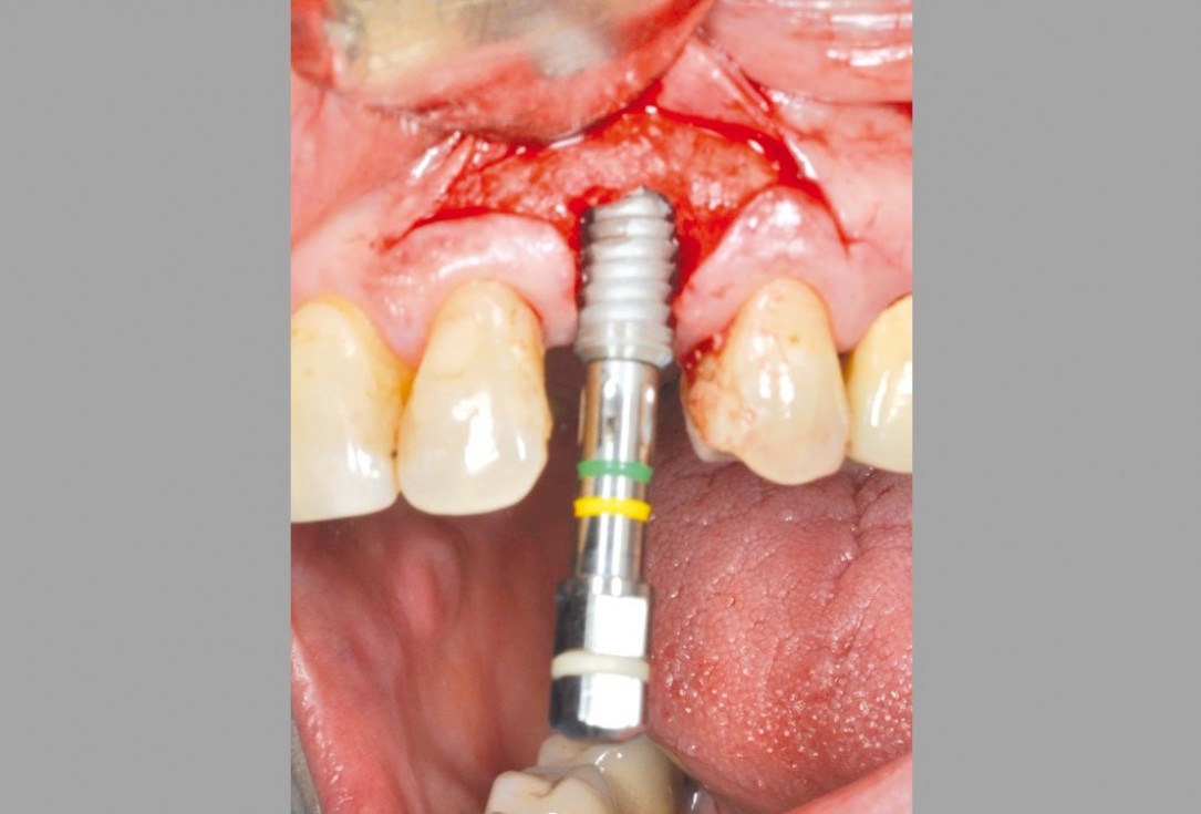 Ridge preservation and reconstruction of the buccal wall using permamem® and cerabone® - Dr. M. Steigmann