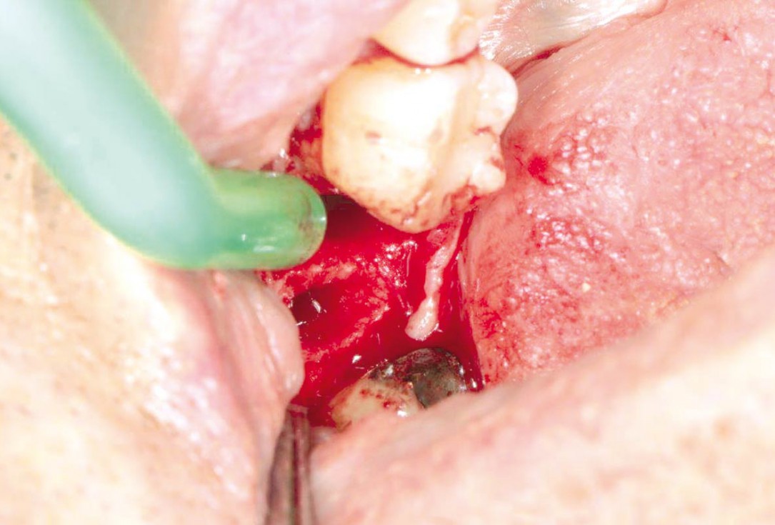 Socket preservation using cerabone®, Jason® membrane and permamem® - Dr. P. Di Capua