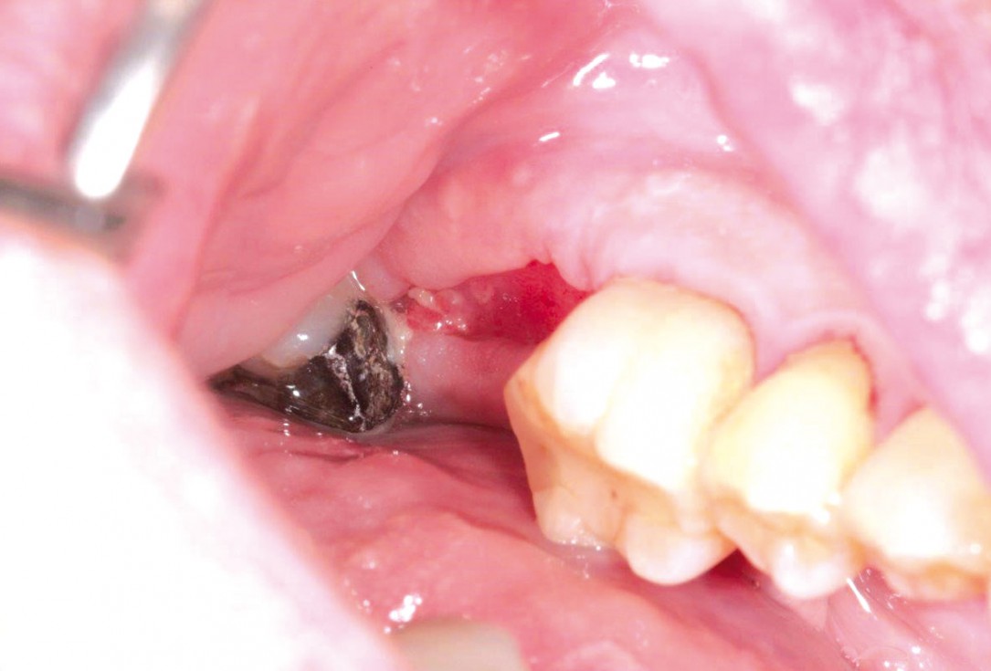 Socket preservation using cerabone®, Jason® membrane and permamem® - Dr. P. Di Capua