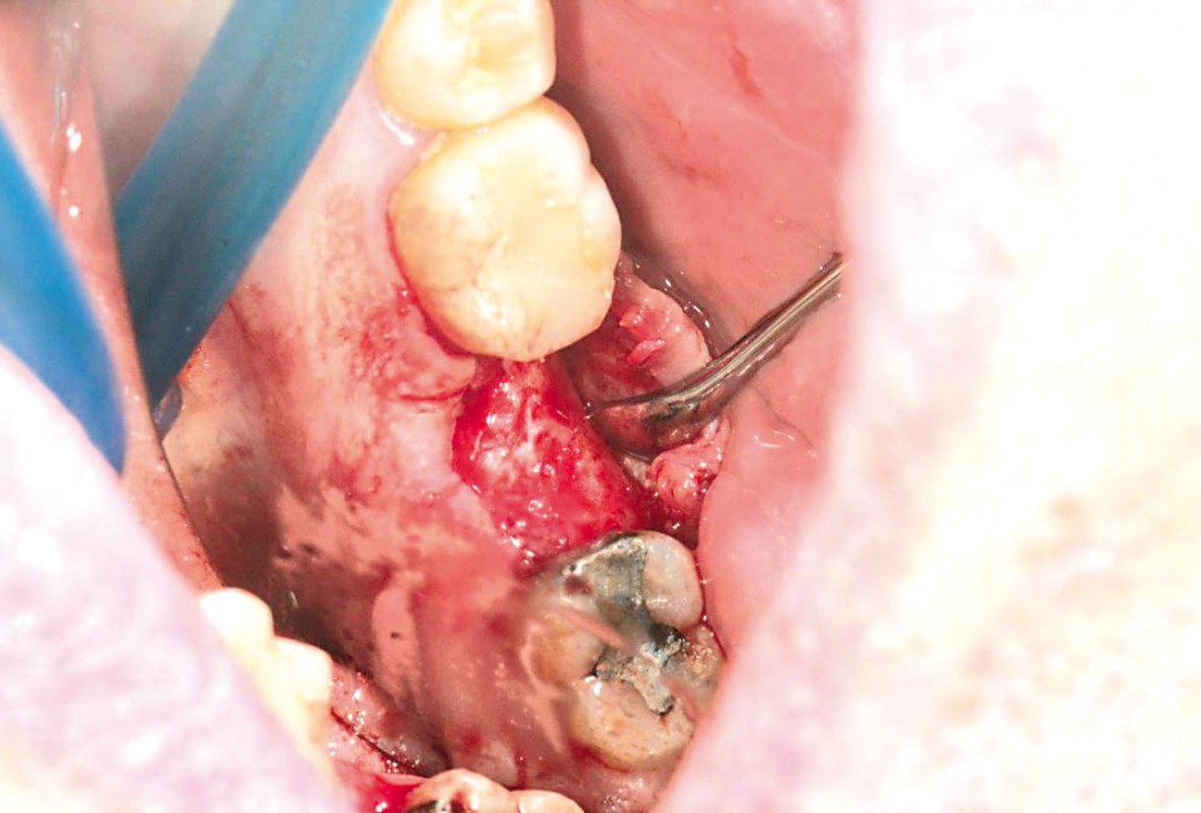 Socket preservation using cerabone®, Jason® membrane and permamem® - Dr. P. Di Capua