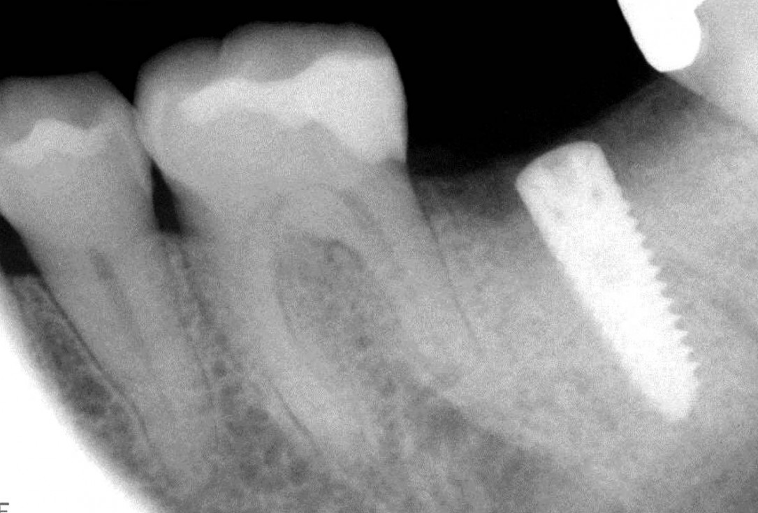 Socket preservation using cerabone®, Jason® membrane and permamem® - Dr. P. Di Capua