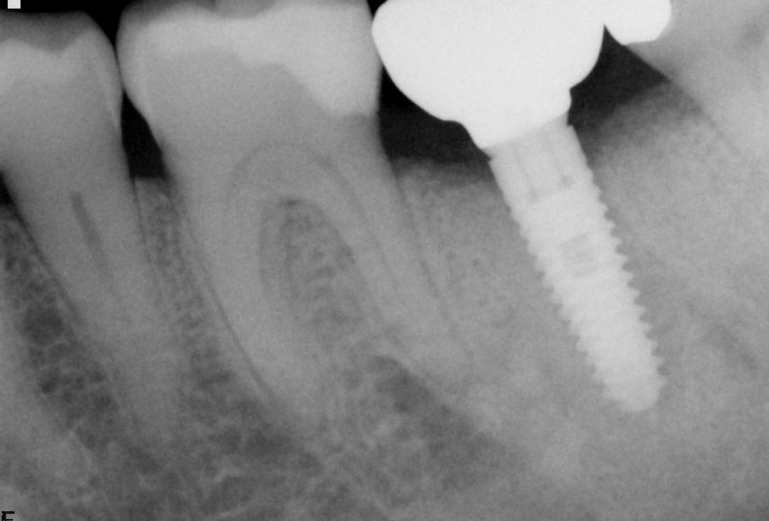Socket preservation using cerabone®, Jason® membrane and permamem® - Dr. P. Di Capua