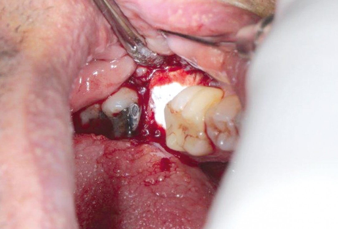 Socket preservation using cerabone®, Jason® membrane and permamem® - Dr. P. Di Capua