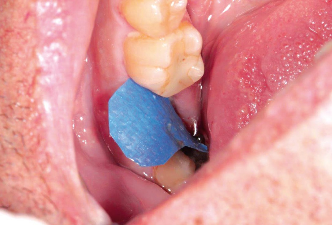 Socket preservation using cerabone®, Jason® membrane and permamem® - Dr. P. Di Capua