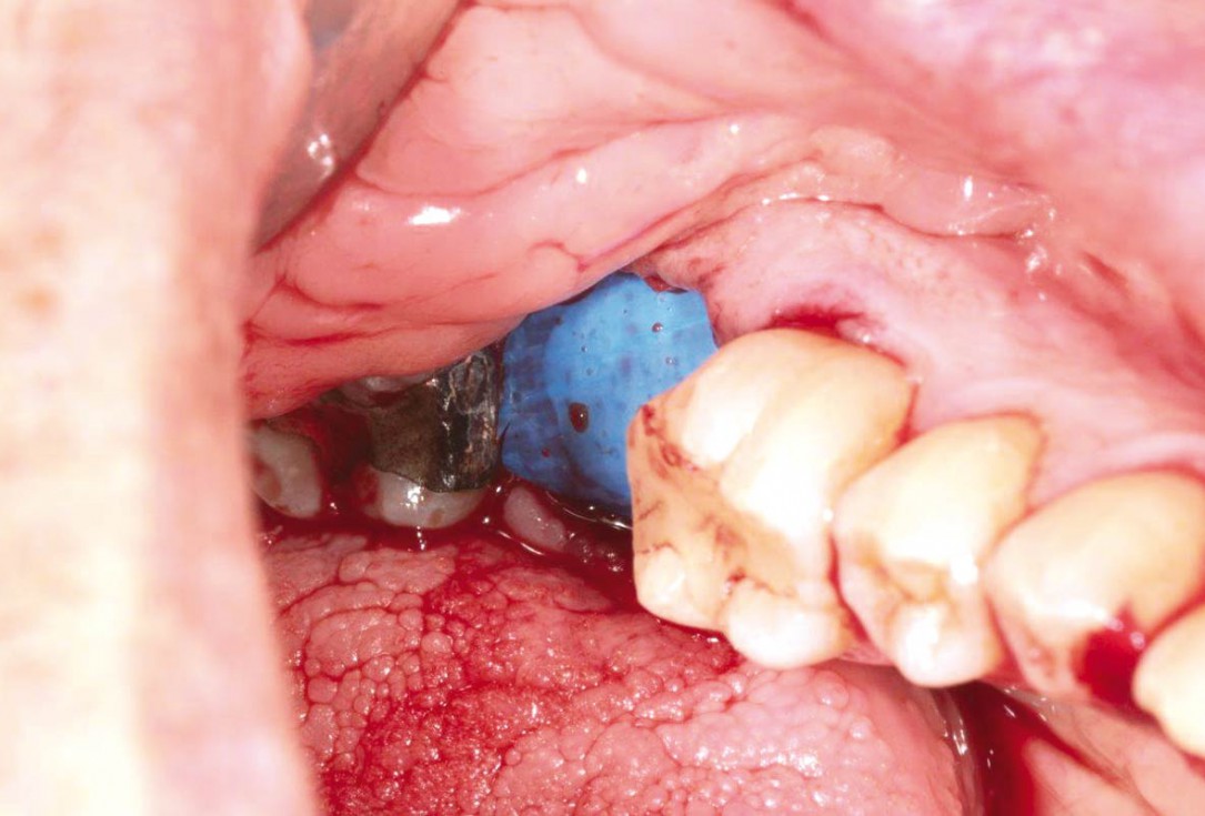 Socket preservation using cerabone®, Jason® membrane and permamem® - Dr. P. Di Capua