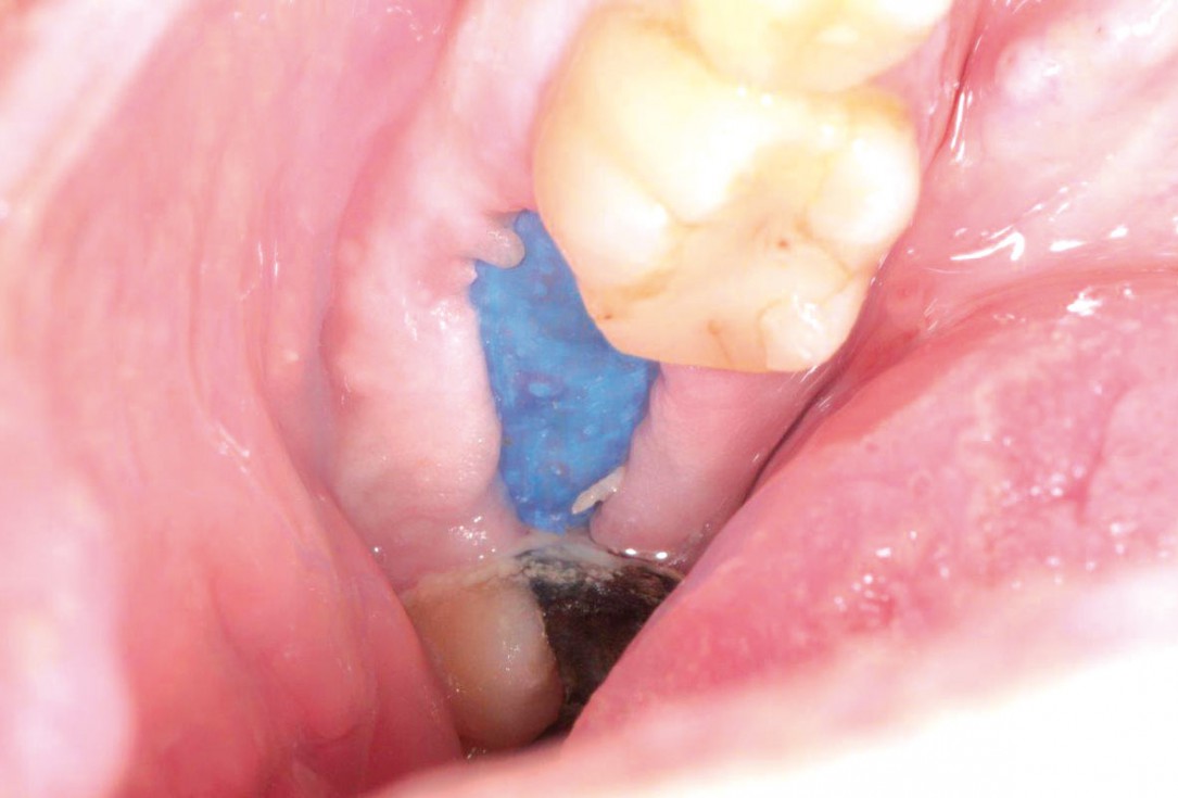 Socket preservation using cerabone®, Jason® membrane and permamem® - Dr. P. Di Capua