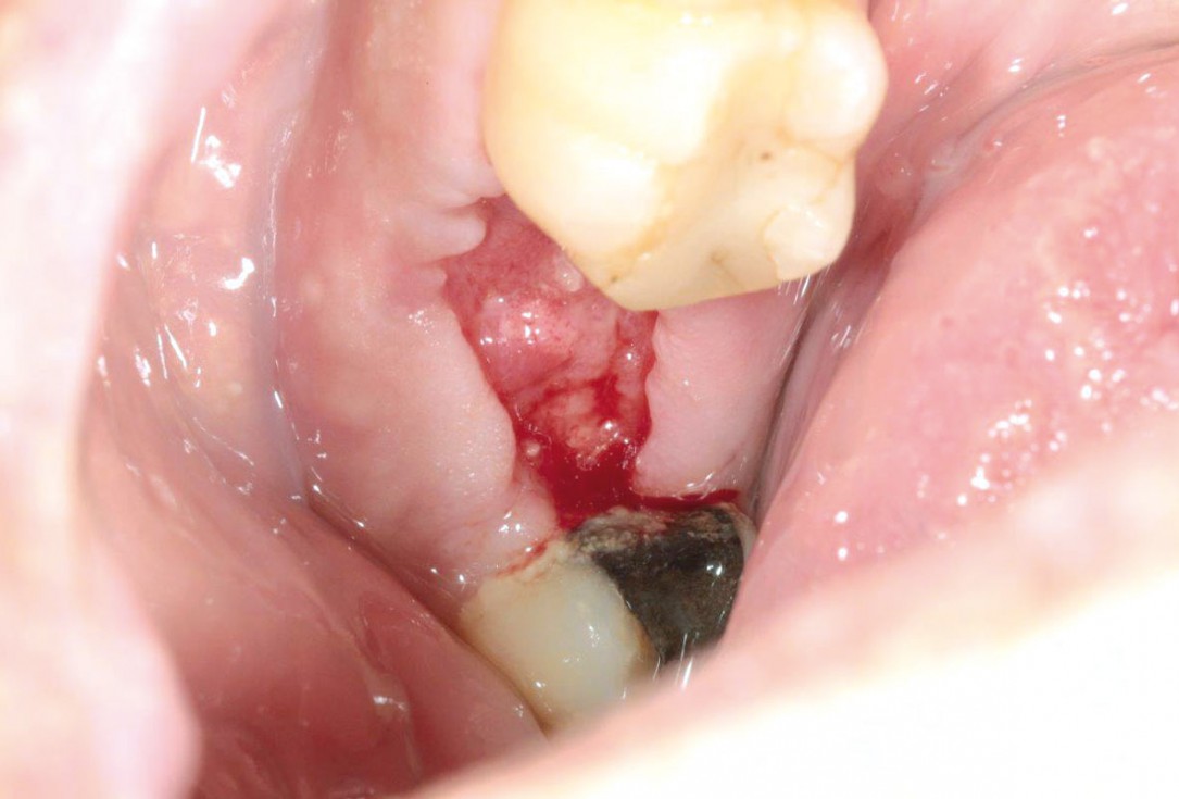 Socket preservation using cerabone®, Jason® membrane and permamem® - Dr. P. Di Capua