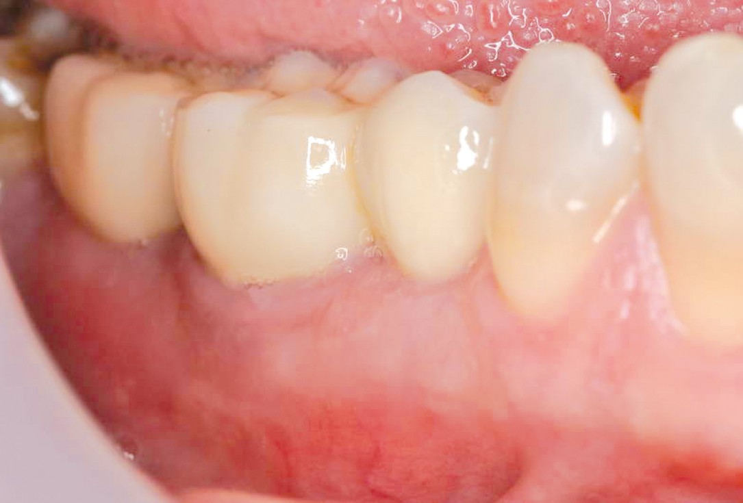 Multiple socket preservation using permamem® and collacone® max - Dr. D. B. Hangyási