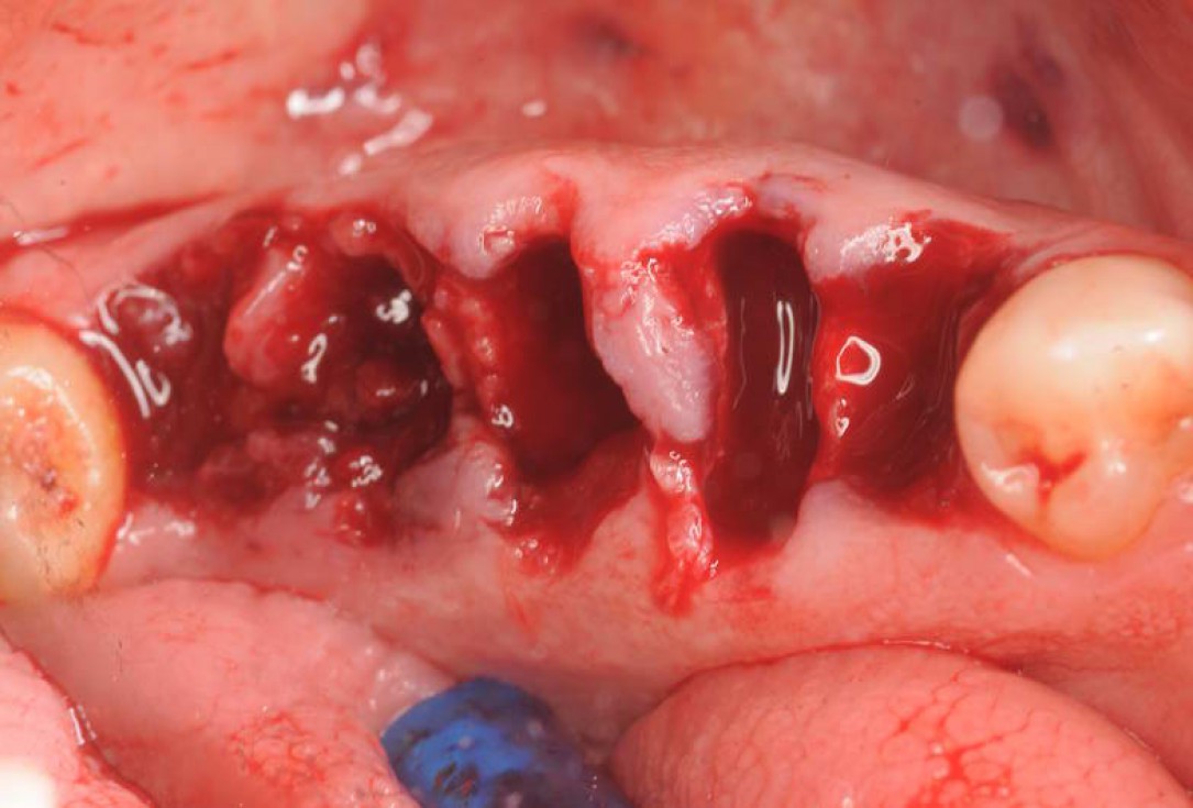 Multiple socket preservation using permamem® and collacone® max - Dr. D. B. Hangyási