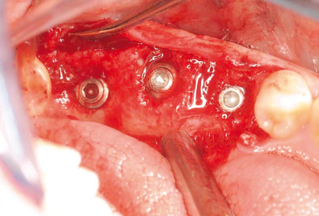 Multiple socket preservation using permamem® and collacone® max - Dr. D. B. Hangyási