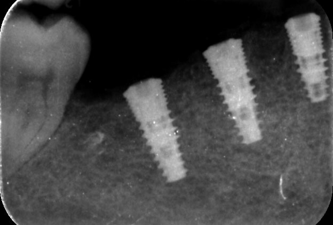 Multiple socket preservation using permamem® and collacone® max - Dr. D. B. Hangyási