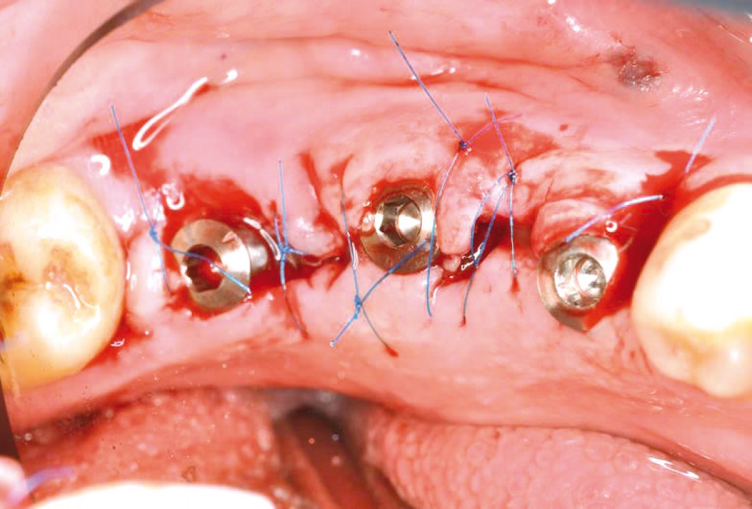 Multiple socket preservation using permamem® and collacone® max - Dr. D. B. Hangyási