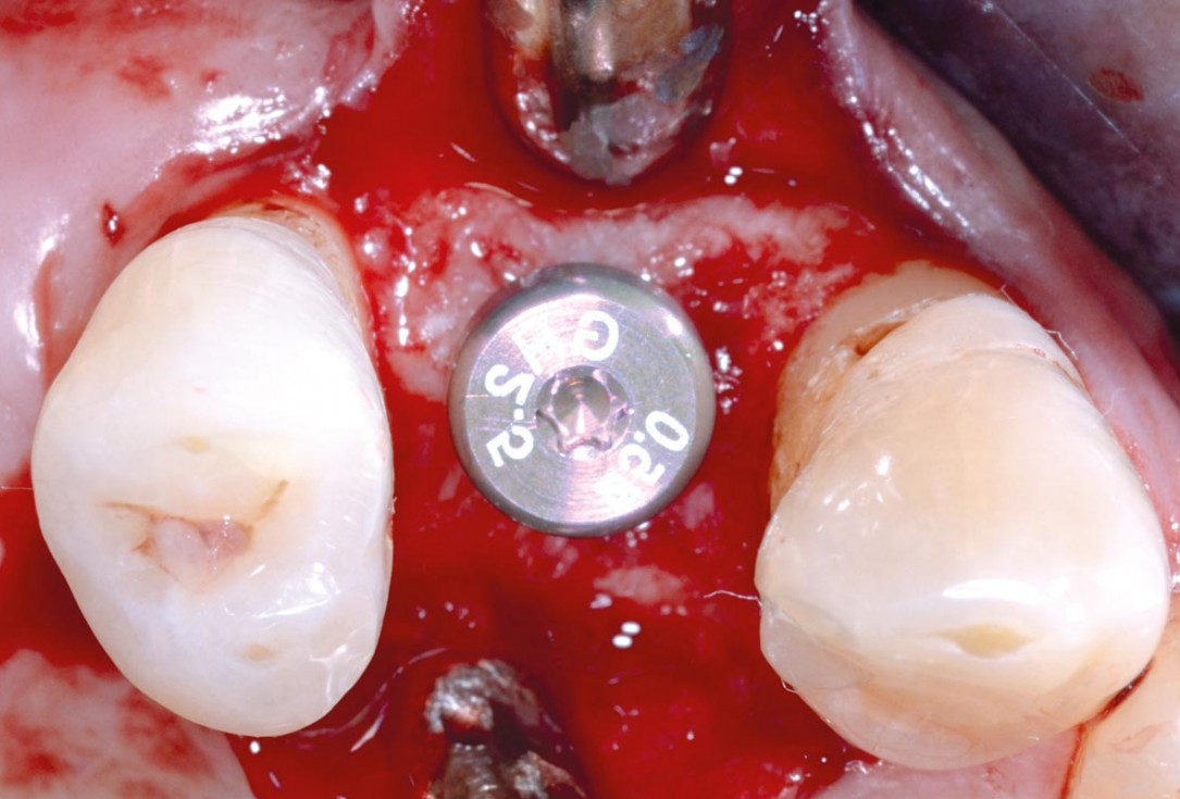 Socket preservation with permamem® - Dr. P. Papi