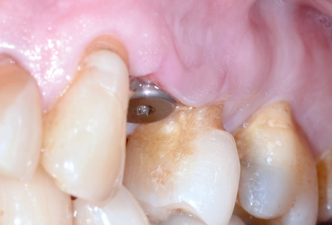 Socket preservation with permamem® - Dr. P. Papi