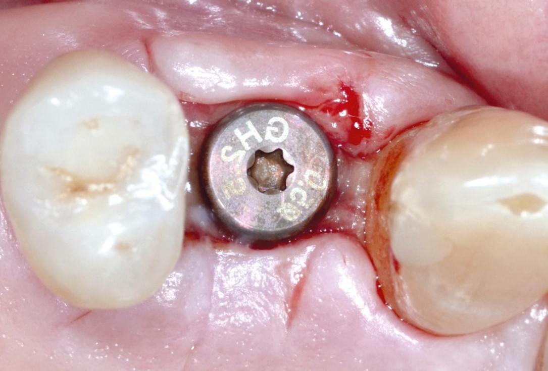 Socket preservation with permamem® - Dr. P. Papi