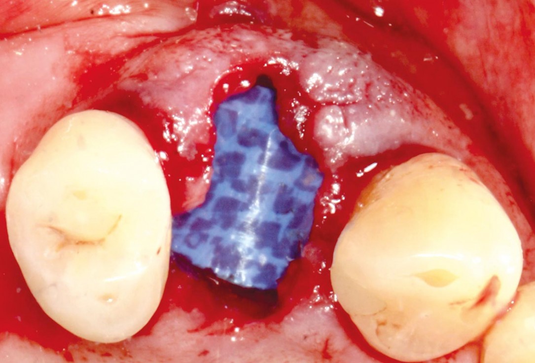 Socket preservation with permamem® - Dr. P. Papi