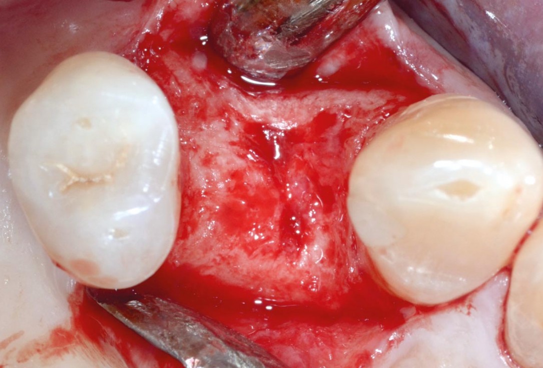 Socket preservation with permamem® - Dr. P. Papi