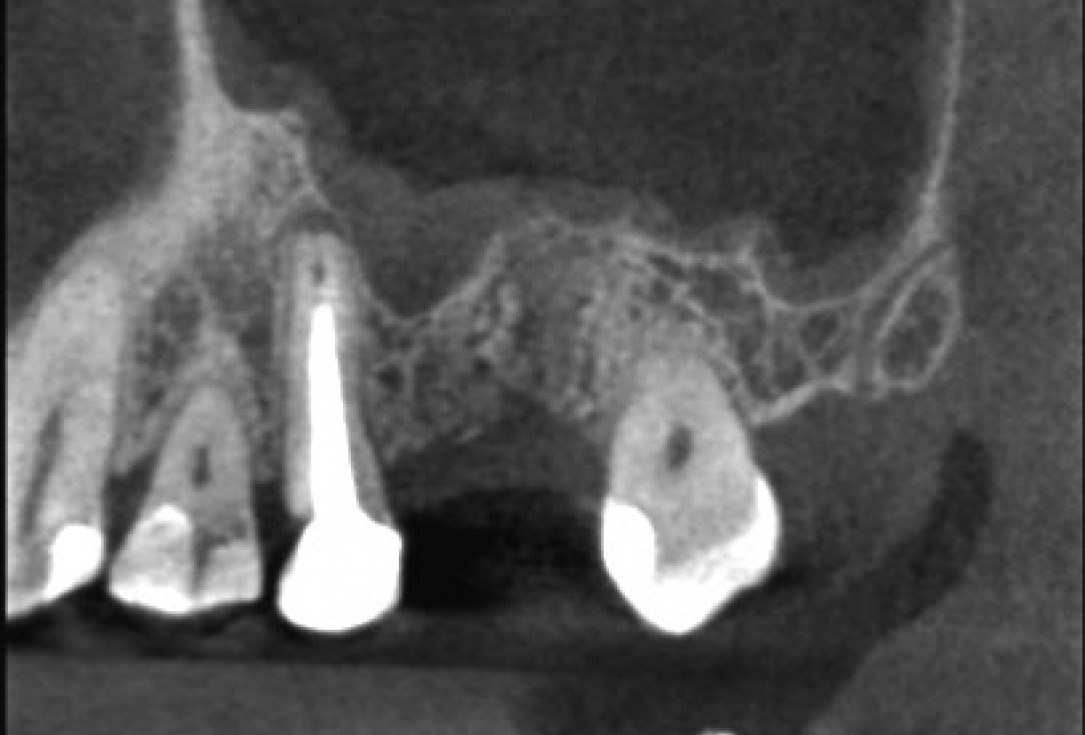 Socket preservation with permamem® - Dr. R. Rannula